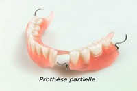 Attachement dentaire Cahors - Fraisage dentaire Rodez