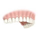 Attachement dentaire Cahors - Fraisage dentaire Rodez